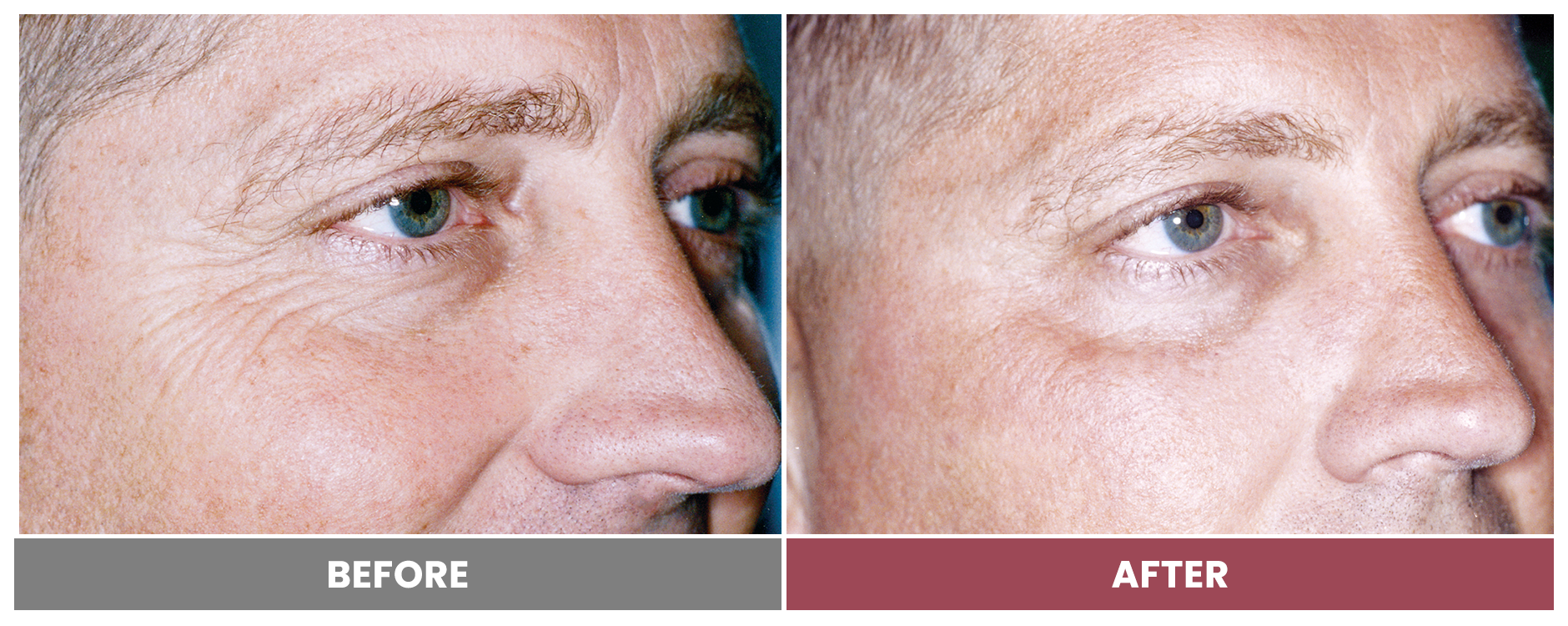 LASER SKIN RESURFACING - Case 1